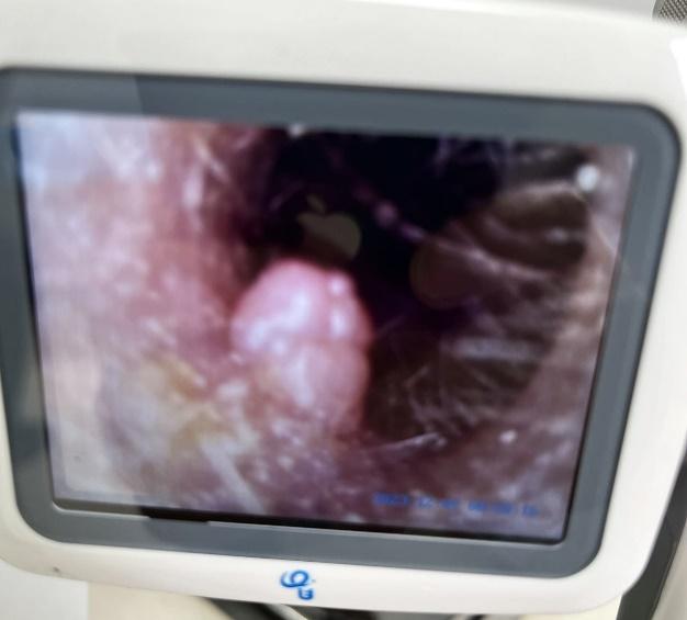 耳内长肿瘤良性与恶性的症状区别,耳内长肿瘤