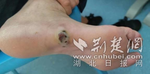 黑痣变成很多个还化脓是什么病呀,足底恶性黑色素瘤死亡率
