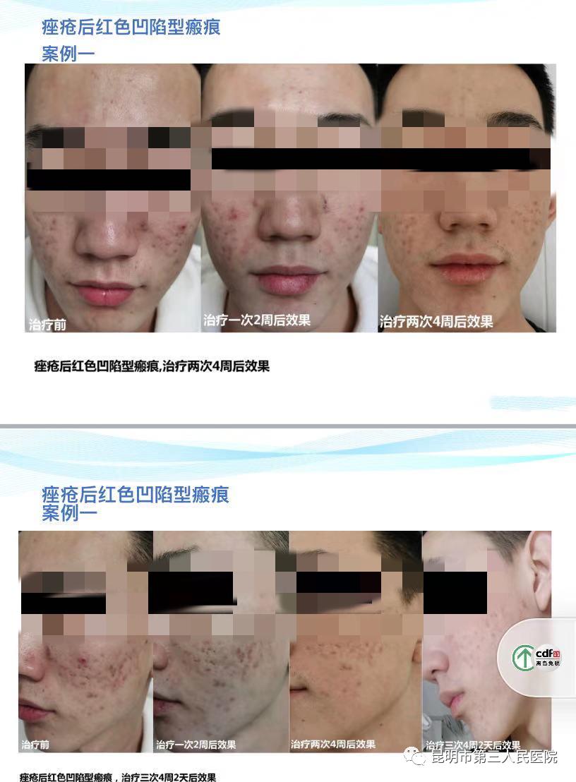 超甜礼遇“6·18”！昆明市三院皮肤科化学换肤术活动来袭