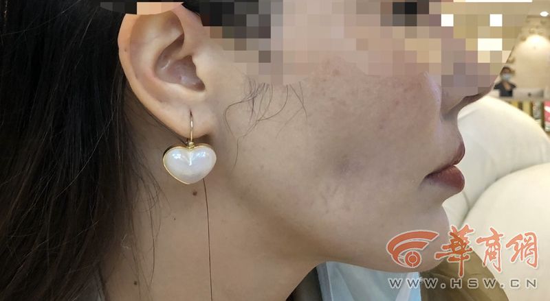 脂肪填充后面部结节,面颊脂肪填充后有硬结需要手术吗