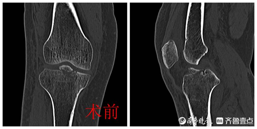 关节镜微创手术二级医院可以做吗,西医治疗粉碎性骨折