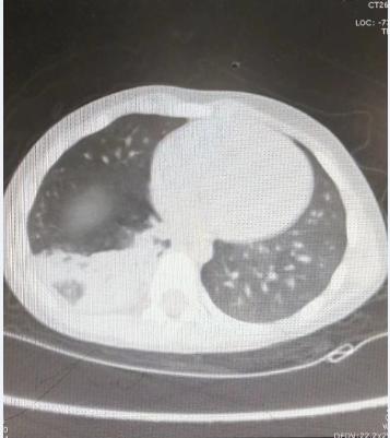 省立三院儿童支气管肺炎,儿童大叶性肺炎纤维支气管镜治疗