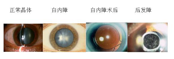 白内障术后复发,白内障手术后复发了是怎么回事