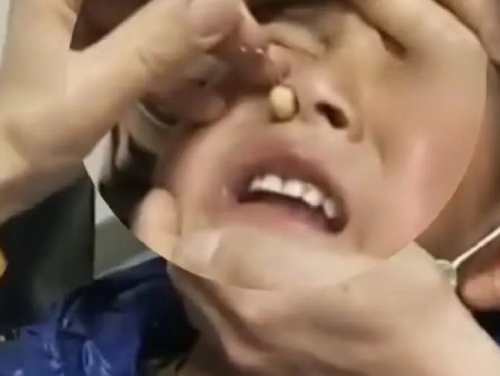 过于自信？女子往鼻孔塞珍珠，结果坏了！