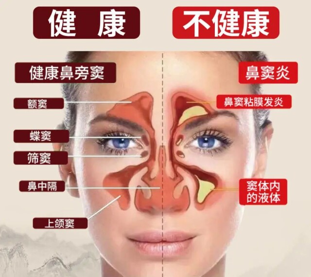 11岁男孩变脸,鼻窦炎导致脸型变化小孩