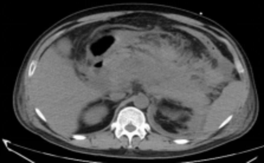 大量饮酒引起的重症胰腺炎,26岁小伙酗酒致胰腺炎每月要住院