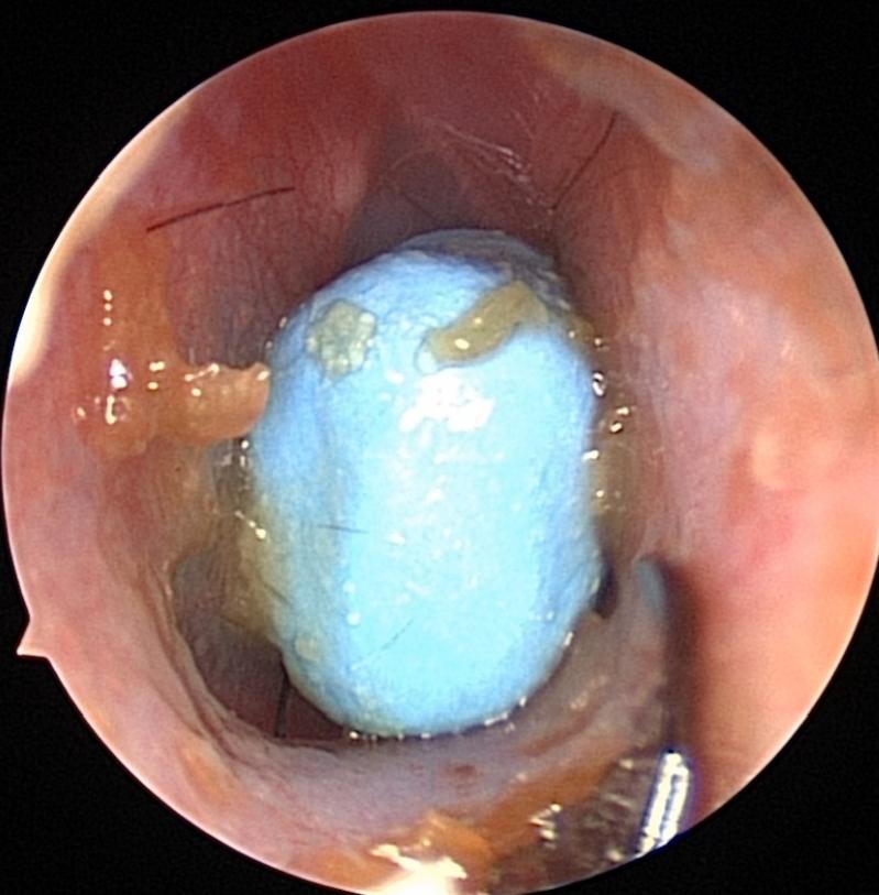 六一关爱,小孩子耳朵塞进异物视频