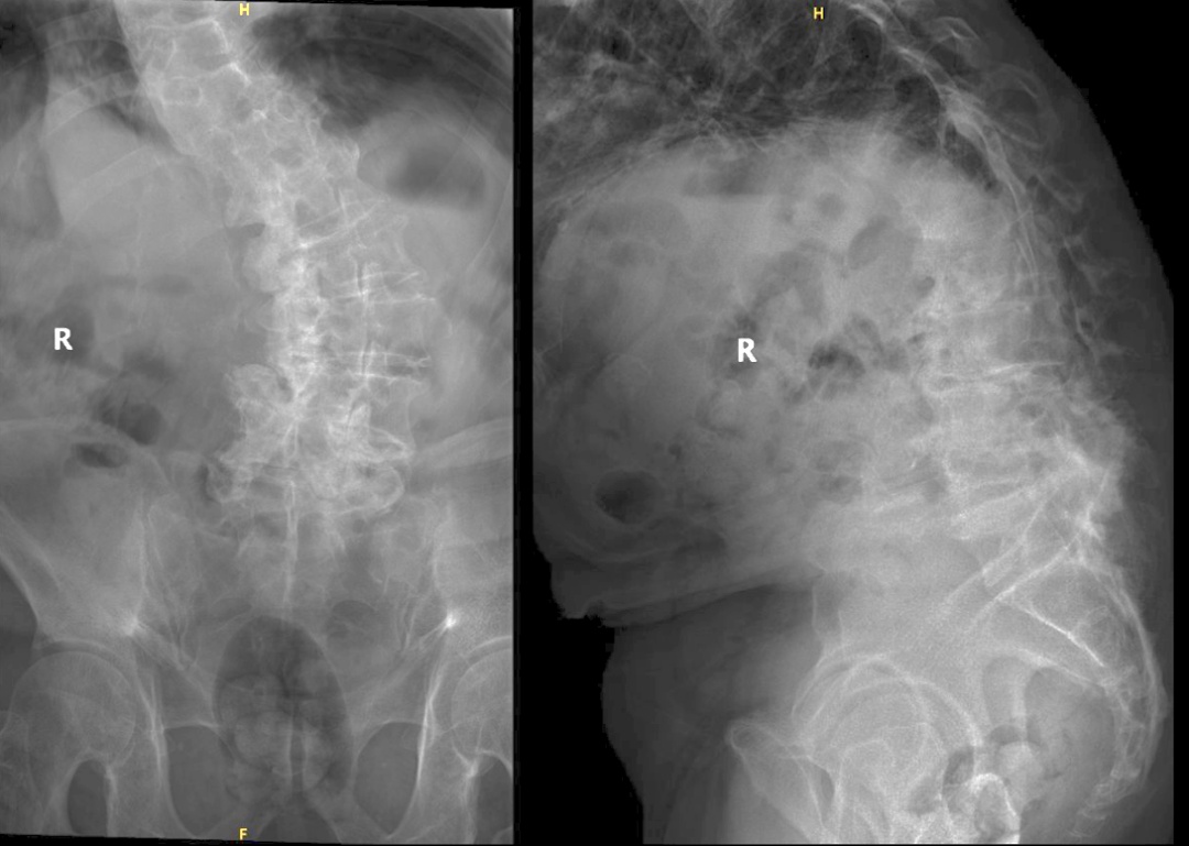 不想疼痛伴随余生，华山医院多学科诊疗助力百岁老人恢复行走