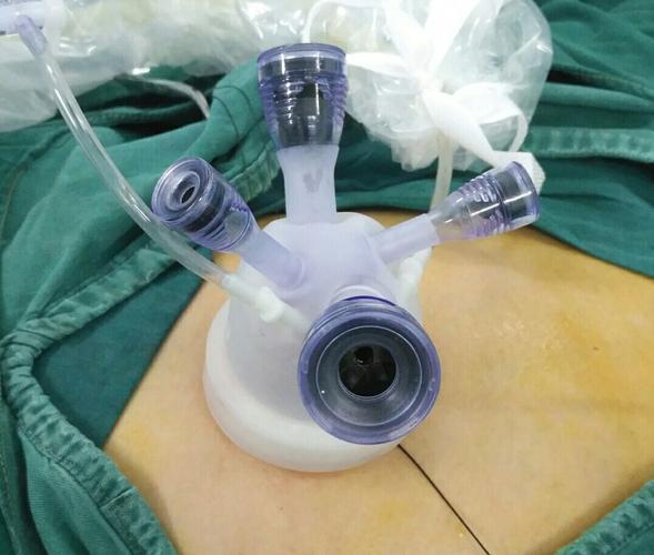 单孔腹腔镜切除卵巢囊肿,寿光哪里做皮脂腺囊肿手术