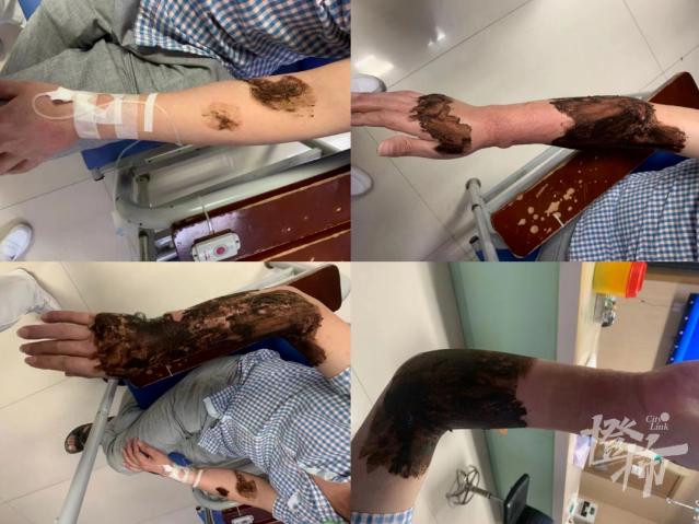 被蚊子叮后肿了一大个包,被蚊子叮了手指头整个肿了